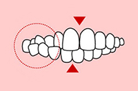 交叉咬合（こうさこうごう）